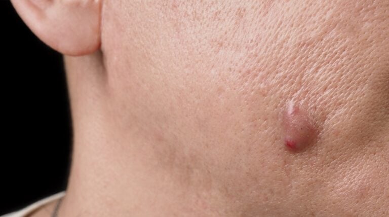 Cysts Treatment| Louisville, KY | Brownsboro Dermatology